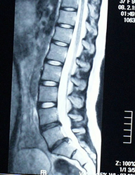 椎間板ヘルニアのMRI画像